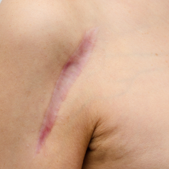 Body scar